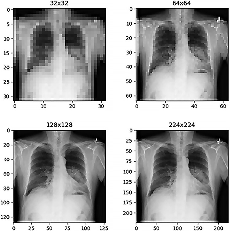 Comparison of chest radiographs at different image resolutions for patient 103 (60-year-old man with a thoracic mass). The mass finding is visible in all images but with visually observable improved clarity in the higher resolution examples (bottom row).