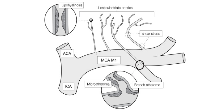 Fig.1. Schematic diagram of a perforating branch lesions of the middle cerebral artery causing the branch atheromatous disease (BAD) or lacunar infarction