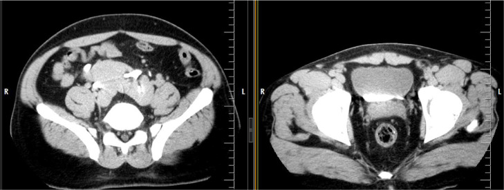 Bilateral, fused pelvic, ectopic, laterally rotated kidneys: A case ...