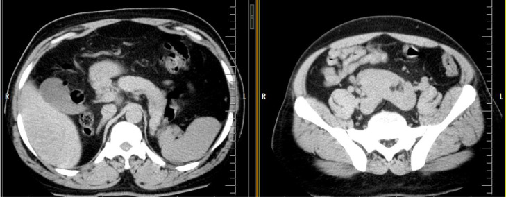 Bilateral, fused pelvic, ectopic, laterally rotated kidneys: A case ...