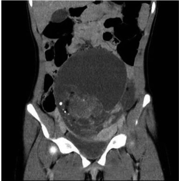 Acute Abdominal Pain In An Adolescent Girl With An Ovarian Yolk Sac 