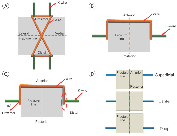 Biomechanical Analysis of the Kirschner-Wire Depth of the Modified ...