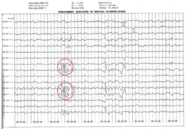 Figure 2: EEG showing intermittent sharp waves (red circled)