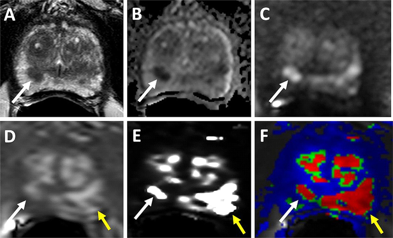 DCE MRI of prostate cancer - PMC