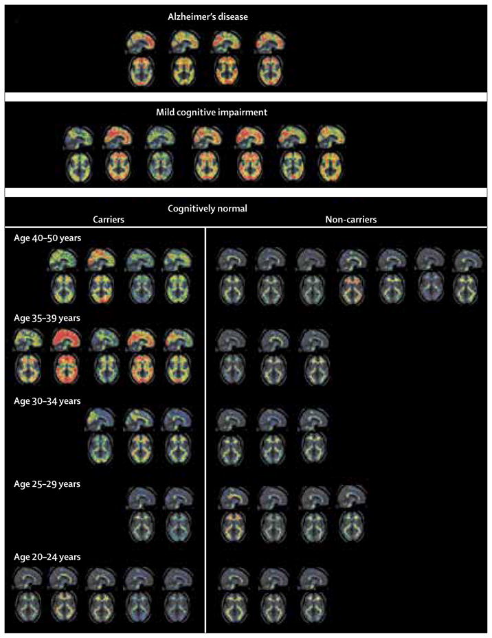 Florbetapir PET analysis of amyloid-β deposition in the presenilin 1 ...