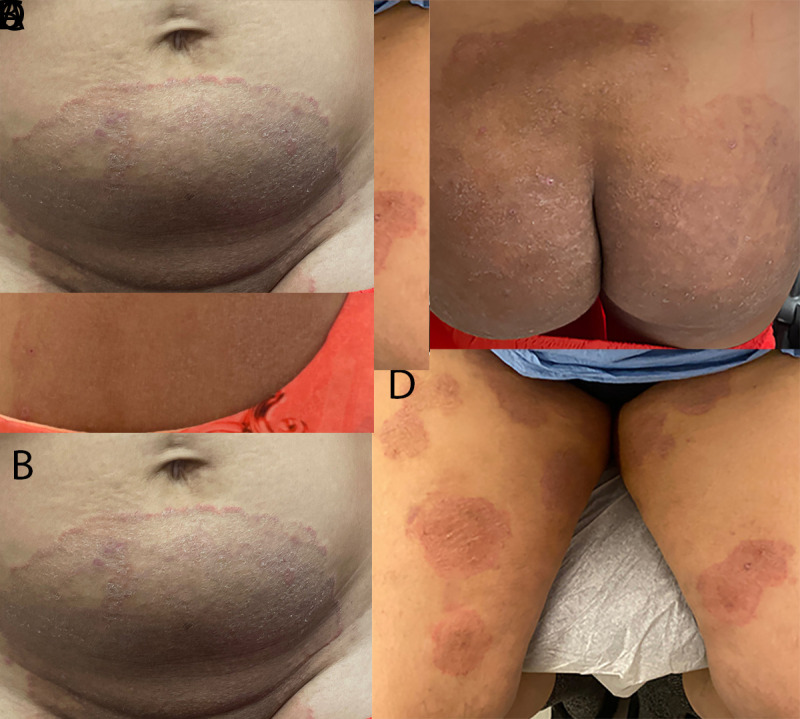 The figure includes four photographs of lesions occurring on the neck, abdomen, and thigh areas of two patients in New York City, caused by the first reported U.S. cases of tinea due to Trichophyton indotineae infection during December 2021–March 2023.