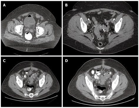 Current indications and role of surgery in the management of sigmoid ...