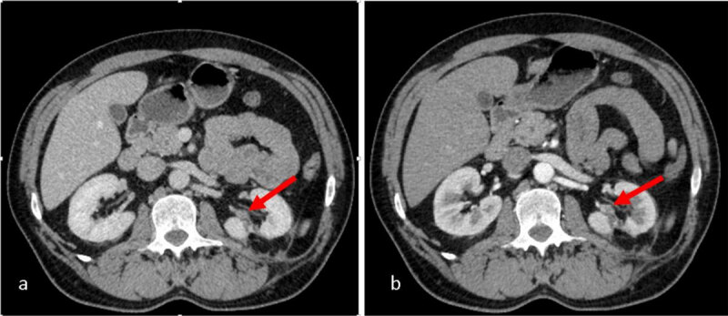 CT scan with CA: a. heterogeneous nodular lesion in the sinus of left remnant kidney; b. the lesion enhances at periphery and has necrotic centre