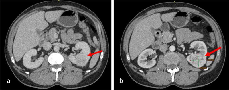 CT scan with contrast administration (CA): a. heterogeneous exophytic nodular lesion in the lower pole of the left kidney with small bulging into sinus, measuring 4.3/5/6 cm (AP/T/CC); b. the lesion enhances at periphery and has an irregular necrotic centre