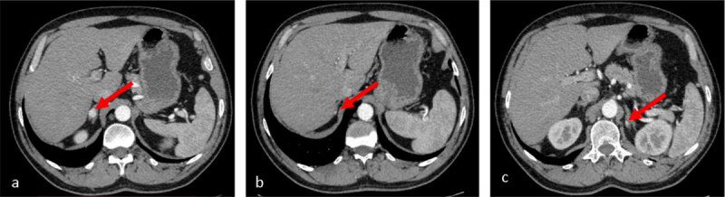 Arterial phase CT scan: a, b. two, nodular, enhancing solid lesions in the right adrenal gland; c. a solitary, nodular, enhancing solid lesion in the left adrenal gland