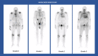 ATTR-CM: whole body anterior planar views – 3 hours post-injection of Tc99 m-DPD