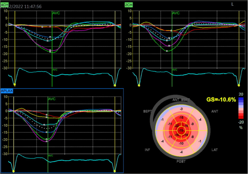 Two-dimensional speckle-tracking strain imaging echocardiography of a patients with ATTRwt-CM