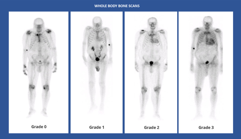 ATTR-CM: whole body anterior planar views – 3 hours post-injection of Tc99 m-DPD