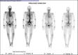 8 ATTR-CM: Whole body anterior planar view and posterior– 3 hours post-injection Tc99 m-DPD