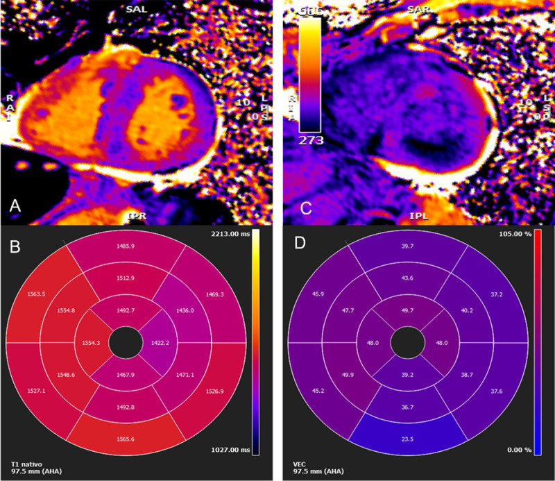 Cardiac magnetic resonance imaging (ATTR-CM): Myocardical native T1 mapping and extracellular volume map