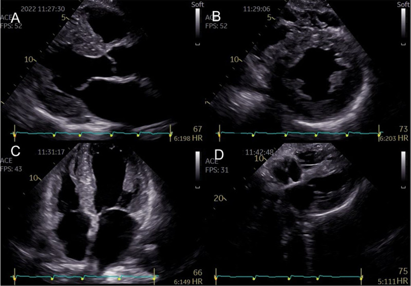 Representative two-dimensional echocardiography features of a patient with ATTR-CM