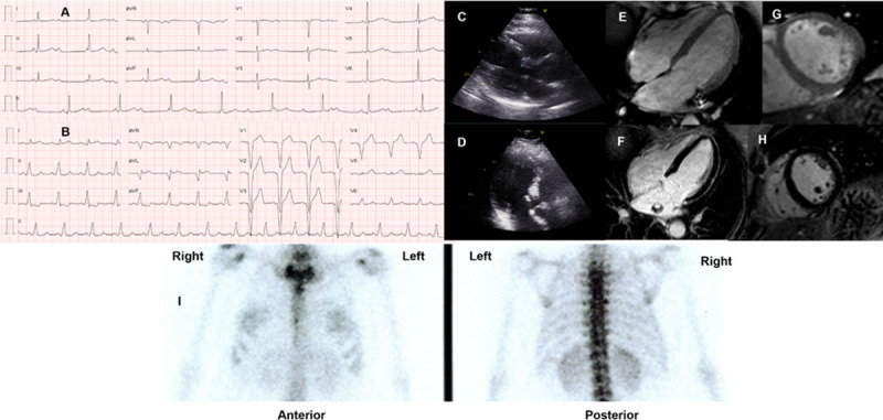 Complete atrial ventricle block of a patient with genetic ATTR amyloidosis