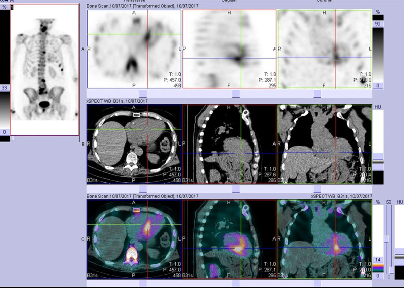 SPECT-CT of a patient with ATTR-CM