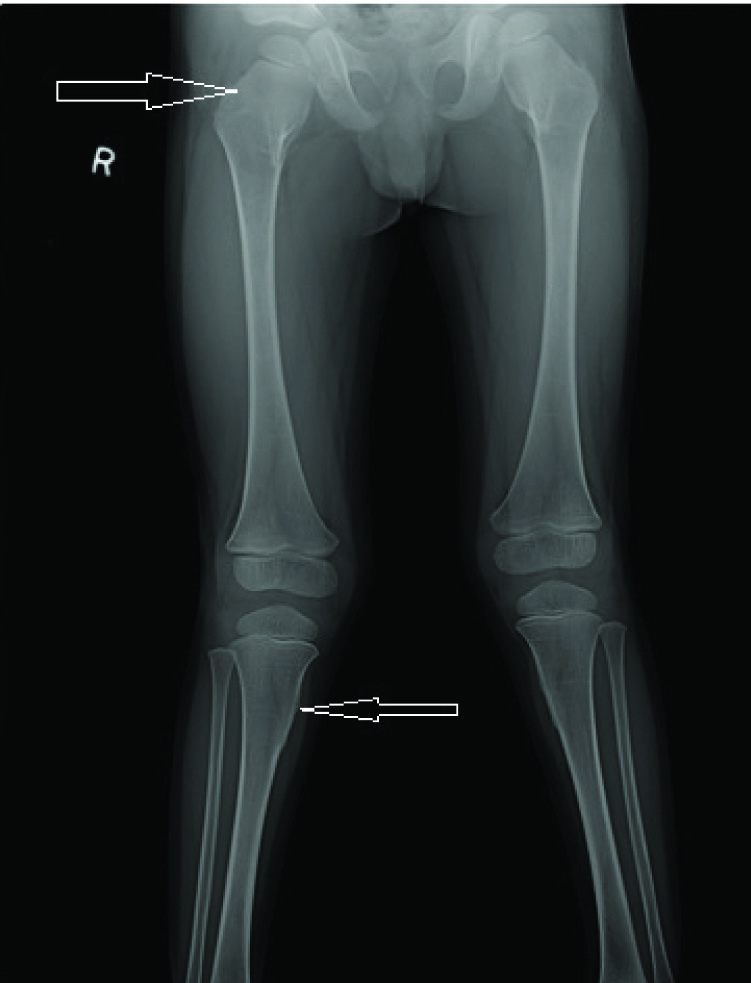 Clinical and Genetic Analysis of Fibrodysplasia Ossificans Progressiva ...