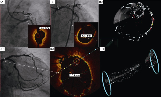 Synergy stent for treating unprotected left main stenosis with the ...