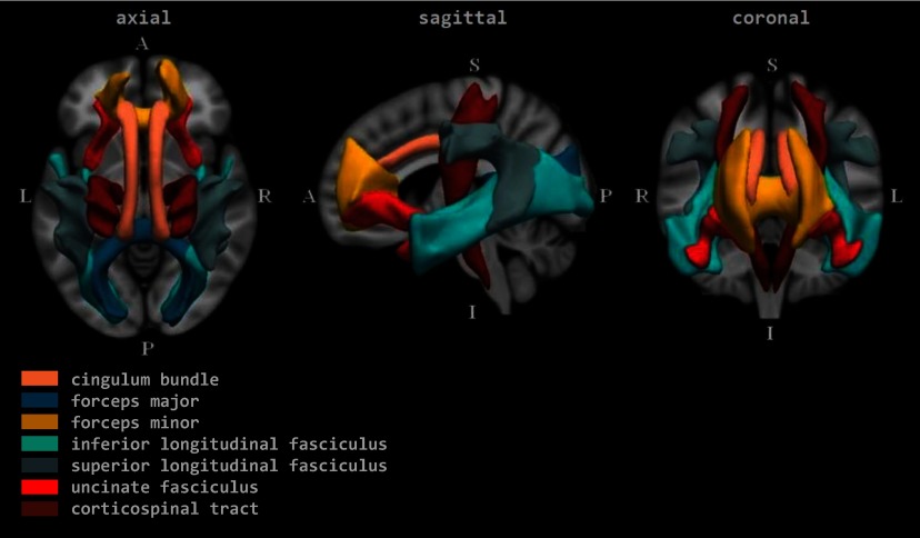 Figure 1 comprises the axial, sagittal, and coronal views of the brain. In the axial, the anterior (at the top) has forceps minor, uncinate fasciculus, and a part of cingulum bundle; the left and right each have inferior longitudinal fasciculus, superior longitudinal fasciculus, forceps major, corticospinal tract, and parts of cingulum bundle; the posterior (at the bottom) has forceps major and inferior longitudinal fasciculus. In the sagittal, the superior (at the top) has parts of the corticospinal tract, cingulum bundle, and superior longitudinal fasciculus; the anterior (on the left) has forceps minor, uncinate fasciculus, a part of the cingulum bundle, and part of inferior longitudinal fasciculus; the posterior (on the right) has forceps major, inferior longitudinal fasciculus, superior longitudinal fasciculus, and a part of the corticospinal tract; the inferior (at the bottom) has the corticospinal tract, uncinate fasciculus, and inferior longitudinal fasciculus. In the coronal, the superior (at the top) has corticospinal tract, parts of cingulum bundle, forceps minor, and superior longitudinal fasciculus; the right and left each have corticospinal tract, superior longitudinal fasciculus, inferior longitudinal fasciculus, cingulum bundle, uncinate fasciculus, and forceps minor; the inferior (at the bottom) has parts of uncinate fasciculus, corticospinal tract, inferior longitudinal fasciculus, and forceps minor.