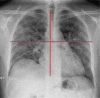 Chest radiography scoring: in a 50-year-old patient with RT-PCR proven coronavirus disease 2019 who was hospitalized but not admitted to the ICU. Chest radiography scoring was as follows: right upper lung zone mild/moderate involvement (1 point), the right lower lung zone mild/moderate involvement (1 points), as well as for the left upper and lower lung zones mild/moderate involvement (both 1 point), resulting in a cumulative score of 4.