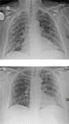 Examples of patients with coronavirus disease 2019 who did (i.e. required intubation and or died) and did not develop critical illness (i.e. did not need intubation and were discharged). A, Radiograph in an 80-year-old woman with 7 days of symptoms prior to emergency ward presentation. She had hypertension and chronic obstructive lung disease as comorbidity. Laboratory findings were as follows: neutrophil granulocytes 6.4x109/L, C-reactive protein 282 mg/L, lactate dehydrogenase 335 IU/L. On chest radiography she exhibited diffuse bilateral opacities and a chest radiography score of 4. The calculated risk score was 0.69. She developed critical illness and died 4 days after hospital admission. B, Radiograph in a 46-year-old woman with no comorbidities had 9 days of symptoms prior to emergency ward presentation. Laboratory findings were as follows: neutrophil granulocytes 3.8x109/L, C-reactive protein 29 mg/L, lactate dehydrogenase 429 IU/L. Chest radiography showed bilateral peripheral opacities and a chest radiography score of 5. The calculated risk score was 0.24. She was not admitted to the ICU and successfully discharged after 2 days of hospitalization.