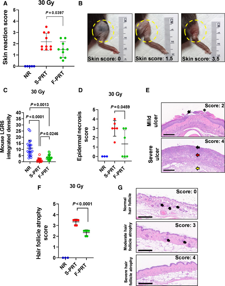 Figure 2. F-PRT alleviates skin damage compared with S-PRT. A, Skin reaction of the irradiated leg after exposure to 30 Gy of F-PRT or S-PRT. Maximum skin score for each mouse is presented over an observation period of 8 months. NR, n = 5; F-PRT and S-PRT, n = 10; statistical analysis by Welch t test. B, Pictures of irradiated skin damage scored as 1.5 or 3.5 compared with untreated skin (score 0); score of 1.5 indicates localized breakdown of the skin with a scaly/crusty appearance, whereas 3.5 corresponds to full-thickness skin barrier loss. C, Quantification of immunofluorescent detection of skin populations of Lgr6+ stem cells at 18 days following 30 Gy of F-PRT versus S-PRT. Lgr6+ cells were quantified on three to four skin sections per mouse (n = 5 mice, statistical analysis by Kruskal–Wallis test followed by Wilcoxon rank sum test.) D, Blinded evaluation of epidermal necrosis in skin hematoxylin and eosin–stained slides, at 27 days after 30 Gy of proton RT. NR, n = 3; F-PRT and S-PRT, n = 5; statistical analysis by Welch t test. E, Representative hematoxylin and eosin images of mild and severe ulceration. On the mild ulcer, black arrow points to ulcerated epidermis and an asterisk indicates a crust. On the severe ulcer, necrosis and inflammation are shown in the epidermis (black arrow), which extends through the dermis (red arrow) and subcutis (yellow arrow). Magnification, ×100. Scale bar, 300 μm. F, Blinded evaluation of hair follicle atrophy in skin hematoxylin and eosin–stained slides at 27 days after 30 Gy of PRT. NR, n = 3; S-PRT and F-PRT, n = 6. Statistical analysis by Welch t test. G, Representative images of hematoxylin and eosin–stained nonirradiated normal hair follicles and hair follicle atrophy of irradiated skin. Top, normal (nonirradiated) skin with normal hair follicle units (black arrows); middle, irradiated skin with hair follicle units (black arrows) that are reduced in number and size; bottom, hair follicles are completely absent. Hematoxylin and eosin, ×200 magnification. Scale bar, 200 μm. Values in A, C, D, and F represent mean ± SD.