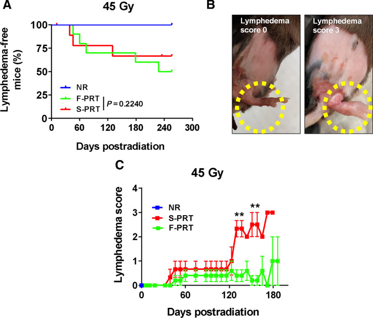 Figure 4. F-PRT reduces the severity of lymphedema. A, Kaplan–Meier curve of lymphedema incidence in mice that received PRT to the hind leg (45 Gy). NR, n = 5; F-PRT and S-PRT, n = 10; statistical analysis by log-rank test. B, Pictures of lymphedema representing scores of 0 (swelling < 1 mm) and 3 (swelling = 3 mm); swelling ≥3 mm mandates euthanasia of the mouse. C, Time course of severity among mice that developed lymphedema. F-PRT, n = 4; S-PRT, n = 3; statistical analysis by multiple cross-sectional t tests with FDR of 0.05; values represent mean ± SEM. **, P < 0.01.