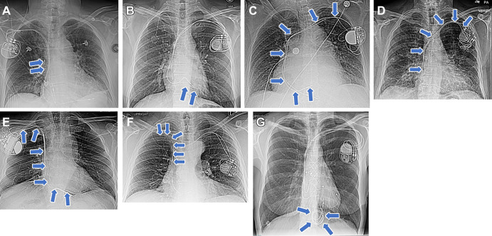 Examples of abandoned or fractured lead orientation on frontal chest radiographs (arrows): (A) vertical fractured lead fragment in a 78-year-old female patient, (B) horizontal fractured lead fragment in a 47-year-old female patient, (C) C-shaped abandoned lead (terminating in the right ventricle) in a 79-year-old female patient, (D) r-shaped abandoned lead (terminating in the superior vena cava or right atrial junction) in a 75-year-old male patient, (E) Z-shaped abandoned lead (terminating in the right ventricle) in a 72-year-old male patient, (F) 7-shaped abandoned lead (terminating in the proximal right atrium) in a 58-year-old male patient, and (G) coiled abandoned lead in a 51-year-old female patient.