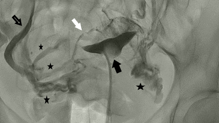 Venous Intravasation During Hysterosalpingography - PMC