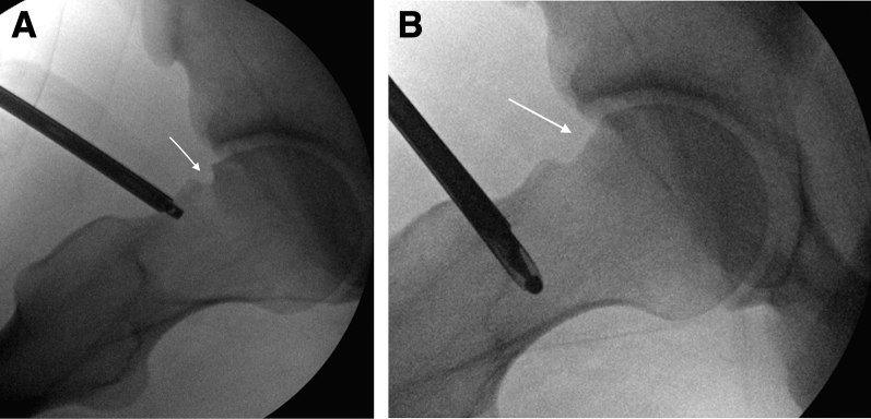 Arthroscopic Femoral Osteochondroplasty for Cam-Type Femoroacetabular ...