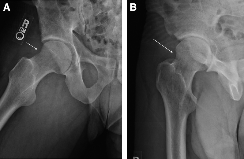 Arthroscopic Femoral Osteochondroplasty for Cam-Type Femoroacetabular ...