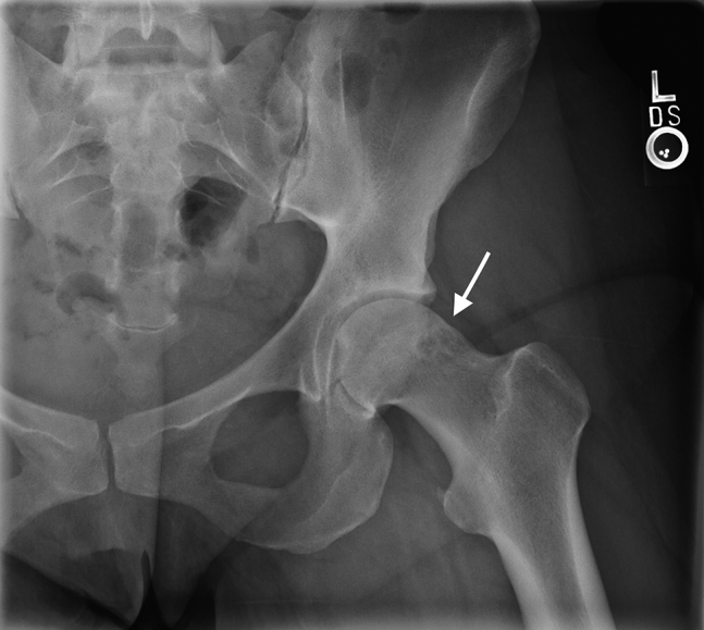 Arthroscopic Femoral Osteochondroplasty for Cam-Type Femoroacetabular ...