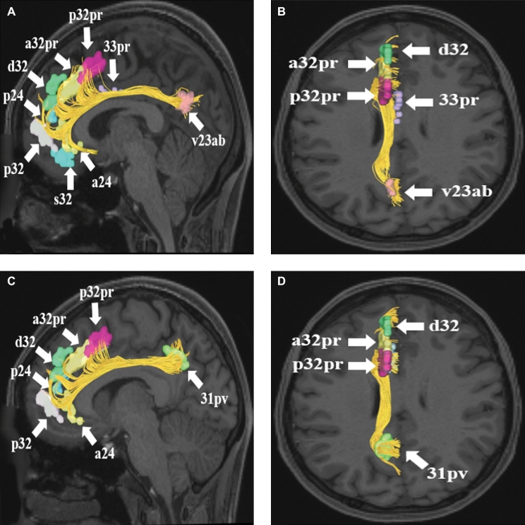 A Connectomic Atlas of the Human Cerebrum—Chapter 17: Tractographic ...