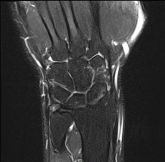 The Value of the Distal Radioulnar Joint Effusion in Diagnosing ...