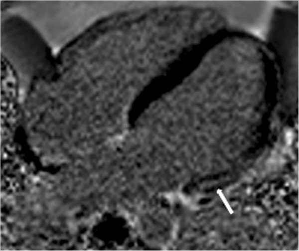 Right and left ventricular function and myocardial scarring in adult ...