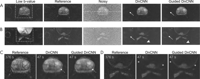 Denoising using denoising convolutional neural network (DnCNN) and guided DnCNNs. A, B, Two separate slices from the same patient. C, D, Zoomed-in view of the boxed regions in A and B. Low b-value images were used in guided DnCNN only. The reference image is a high b-value diffusion-weighted (DW) image reconstructed using 16 averages corresponding to an acquisition time of 376 seconds. Noisy image is a high b-value DW image reconstructed using two averages corresponding to an acquisition time of 47 seconds. DnCNN and guided DnCNN correspond to a noisy image denoised using either original DnCNN or guided DnCNN. Anatomic structures are better visualized on guided DnCCN images compared with DnCNN images; for example, the right hip joint (arrows in A and B), rectum (arrowheads in B), junction between the peripheral zone and transition zone (dashed arrows in C), and bladder wall (* in D). White dashed line in the noisy image in A shows the location of the intensity profiles plotted in Figure 4. Acquisition times are proportional to the repetition time of 7833 msec, three diffusion directions, and corresponding number of averages.