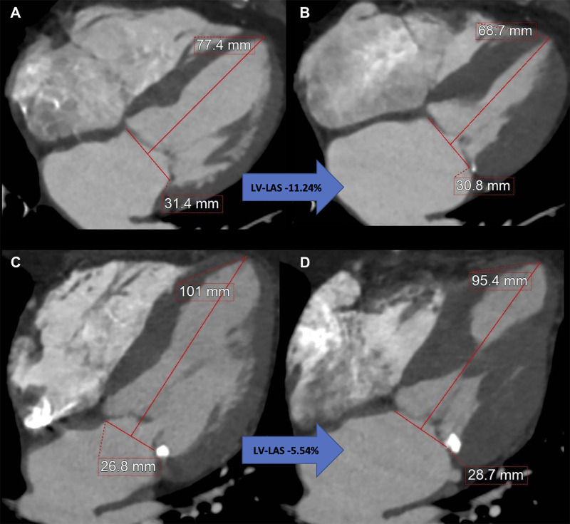 Measurement of coronary CT angiography–derived left ventricular (LV) long-axis shortening (LAS) using a reconstructed four-chamber view. Images at (A) end diastole and (B) end systole in an 87-year-old woman with LV-LAS of −11.24%, an ejection fraction of 75%, and a Society of Thoracic Surgeons Predicted Risk of Mortality (STS-PROM) of 6.0% who remained alive after undergoing transcatheter aortic valve replacement (TAVR) for severe aortic stenosis. Images at (C) end diastole and (D) end systole in an 88-year-old man with LV-LAS of −5.54%, an ejection fraction of 67%, and an STS-PROM of 3.6% who died 9 months after undergoing TAVR for severe aortic stenosis.