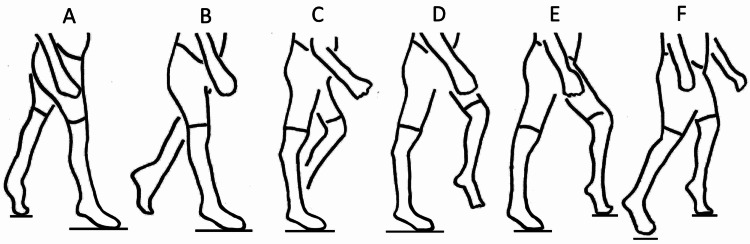 Recurvatum of the Knee in Cerebral Palsy: A Review - PMC