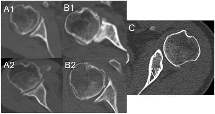 Glenoid bone loss in primary and revision shoulder arthroplasty - PMC