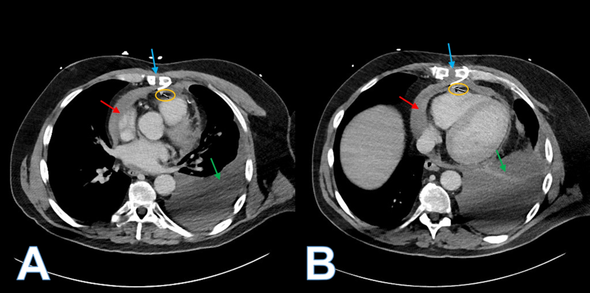 Fractured sternal wire causing a cardiac laceration - PMC