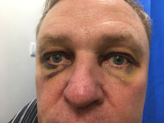 A man with panda eyes after a fall - PMC