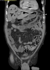 CT of abdomen shows venous air embolism in RV and portal system