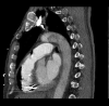 CT of RV air embolism extending to pulmonary trunk