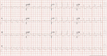 Electrocardiogram with right bundle branch block
