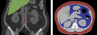 Automated body composition tools for metabolic syndrome in an asymptomatic 60-year-old woman. Coronal noncontrast (left) and axial (right) CT images show liver attenuation (green shading), aortic calcium (red shading, left), and abdominal segmentation and quantification of visceral (blue shading, right) and subcutaneous (red shading, right) fat. In this case, automated mean liver attenuation was 34 HU (95th percentile), which indicates moderate to severe steatosis. The automated Agatston score was 2781 (92nd percentile), and the automated L1-level visceral fat area was 326 cm2 (95th percentile for women, 91st percentile overall). This patient had a myocardial infarction 3 years after the CT examination and died within 1 year after that.