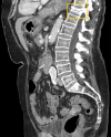 Automated detection of a vertebral fracture with two different algorithms in two patients. (a) Composite CT image in a 62-year-old woman with a severe osteoporotic compression fracture of the L1 vertebral body shows the use of an algorithm for automated detection and characterization of fractures that involves the use of a height compass approach (red and green lines, left). The geometric arrangement of the compass-like layout consists of a central circular sector surrounded by two ring-shaped finite thickness concentric bands. The sagittal CT image (left) shows vertebral column segmentation and partitioning. The adjacent image (right) shows the stacked-height compass of the entire vertebral column. The circular images show the height compasses for a grade-3 wedge fracture at L1 (middle) and preserved vertebral height at T12 (top) and L5 (bottom). The patient underwent spine DXA less than 2 months earlier that was interpreted as normal (T-score, −0.5). (b) Sagittal CT image in an 85-year-old woman shows a severe T11 compression deformity (yellow rectangle), which was detected with a different automated deep-learning algorithm. (Fig 5b courtesy of Einav Blumenfeld, Zebra Medical Systems.)