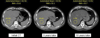 Changes in liver fat content over time. Axial noncontrast CT images acquired over a decade in an asymptomatic man who was 51 years of age at the time of initial imaging show substantial variation in liver attenuation in the ROI (yellow circle) corresponding to a liver fat fraction change of greater than 20%. Note the excellent agreement between the automated and manual measures of liver attenuation. Also note how little body mass index (BMI) has changed over time. (Reprinted, with permission, from reference 20.)