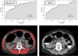 Sarcopenia for prediction of future hip fractures. ROC curves (top) for prediction of hip fractures over a 2-year period show that automated CT-based measurement of muscle attenuation in Hounsfield units (HU) alone (top left, AUC = 0.75) surpasses the multivariate FRAX score (top right, AUC = 0.73). When bone and muscle attenuation are combined (not shown), the performance is further improved (AUC = 0.76). Axial CT image (lower left) shows automated L3-level muscle segmentation in a 54-year-old asymptomatic woman. Mean muscle attenuation was −1.2 HU (98th percentile). Axial CT image (lower right) shows aortic calcium (red shading) with an automated Agatston score of 4283 (96th percentile). The patient had a myocardial infarction 3 months later, had a left hip fracture 1 year after that, and died 3 years later at age 58. (ROC curves reprinted, with permission, from reference 24.)